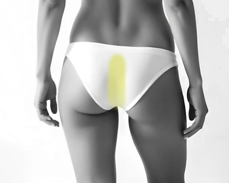 Depilación láser interglúteo mujer (6 sesiones + 2 sesiones GRATIS)