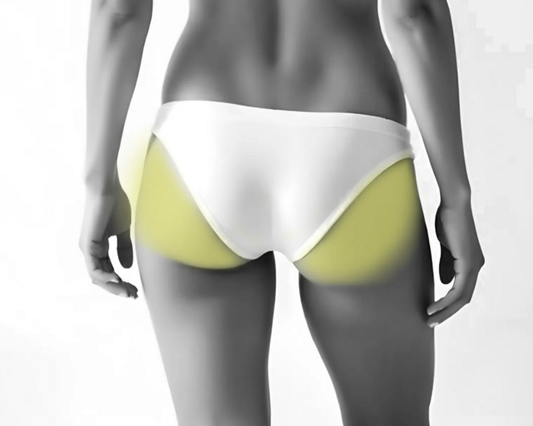 Depilación láser glúteos mujer (6 sesiones + 2 sesiones GRATIS)