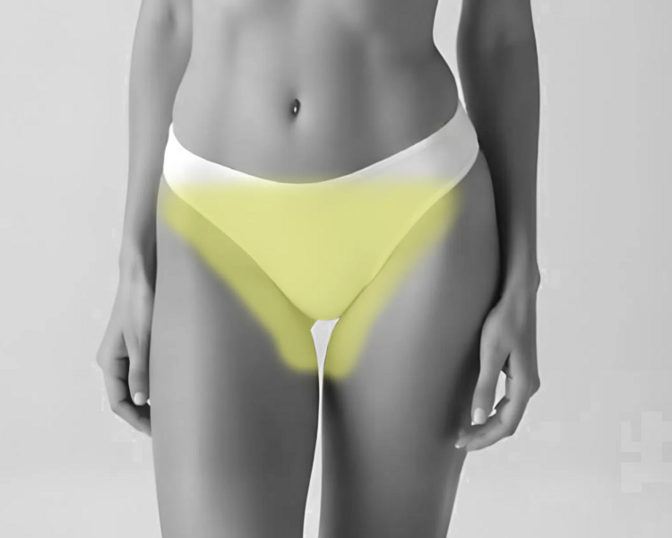 Pack: Depilación láser rebaje total e interglúteo mujer (6 sesiones + 2 sesiones GRATIS)