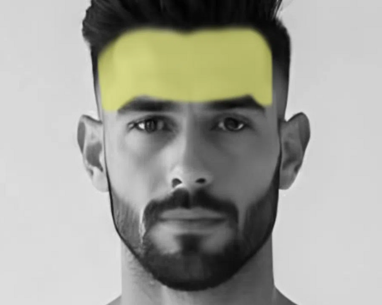 Depilación láser frente hombre (6 sesiones + 2 sesiones GRATIS)