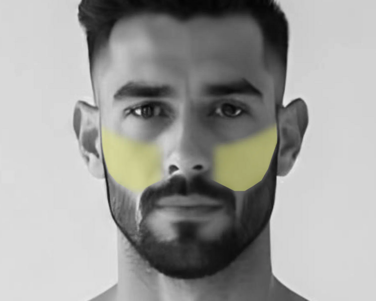 Depilación láser mejillas hombre (6 sesiones + 2 sesiones GRATIS)