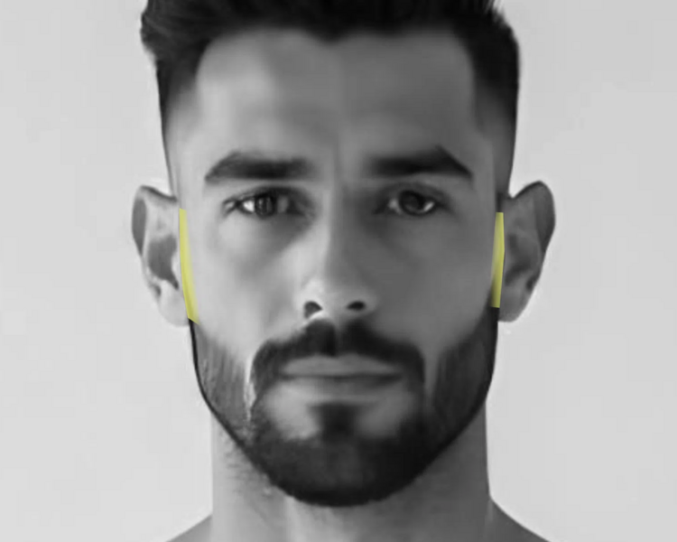 Depilación láser patillas hombre (6 sesiones + 2 sesiones GRATIS)