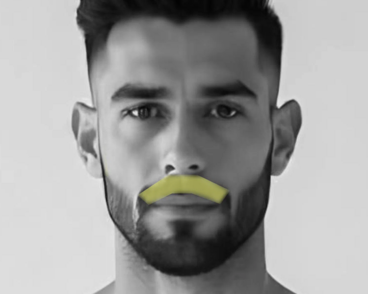 Depilación láser bigote (6 sesiones + 2 sesiones GRATIS)