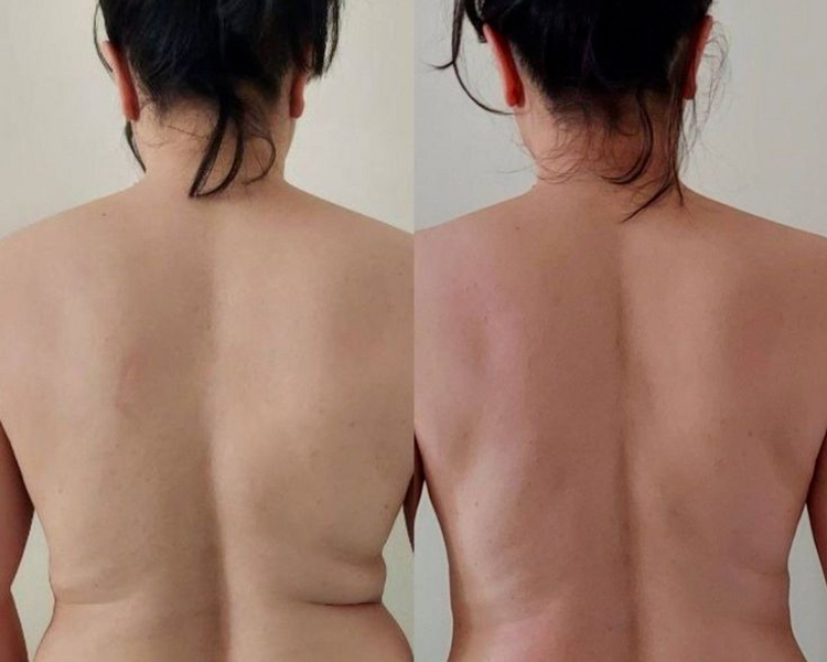 criolipolisis