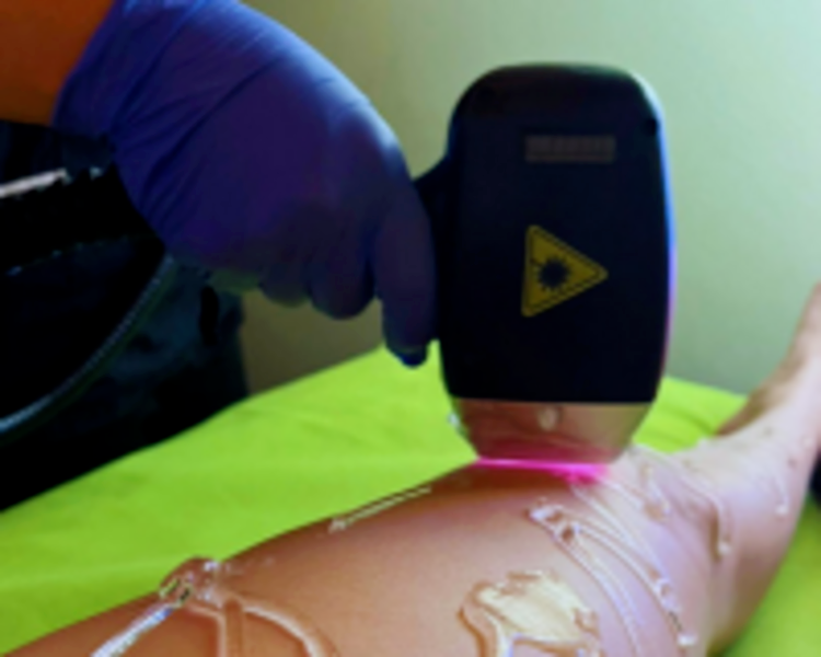 Depilacion Definitiva Laser Abdomen Completo 