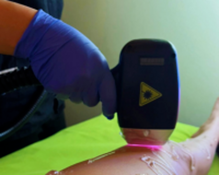 Depilación Definitiva Laser Brazos