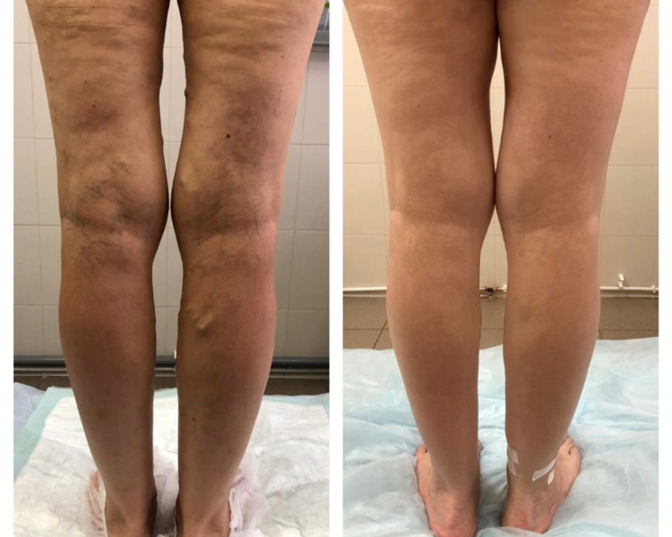 PRESOTERAPIA EN PIERNAS 