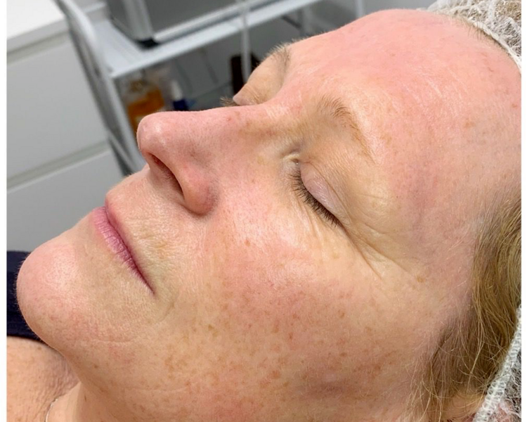 BIOLIFTING FACIAL PAQ