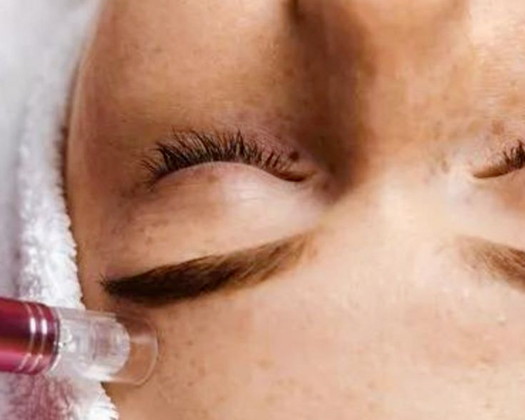 Higiene Facial Profunda + Peeling + Microoneedling 