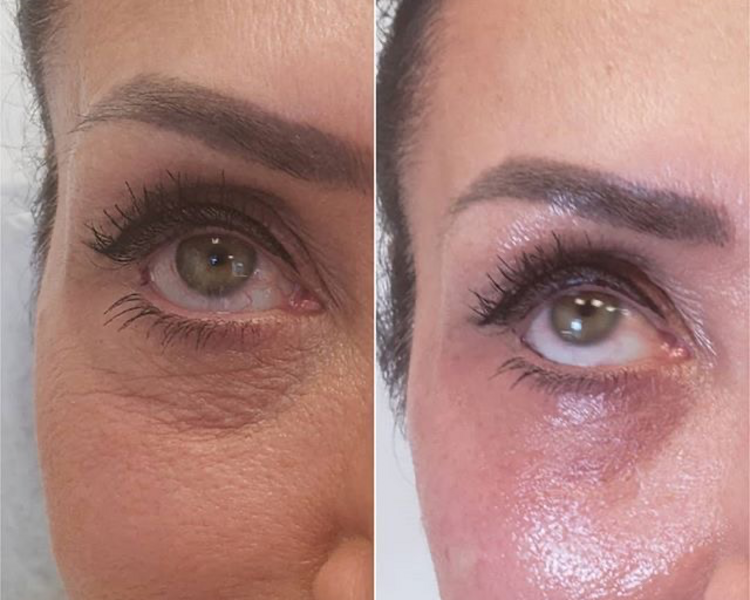 BLEFAROPLASTIA  SIN CIRUGIA