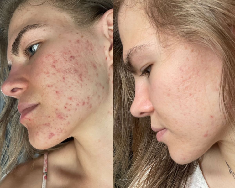 SECUELAS Y MANCHAS DE ACNE 