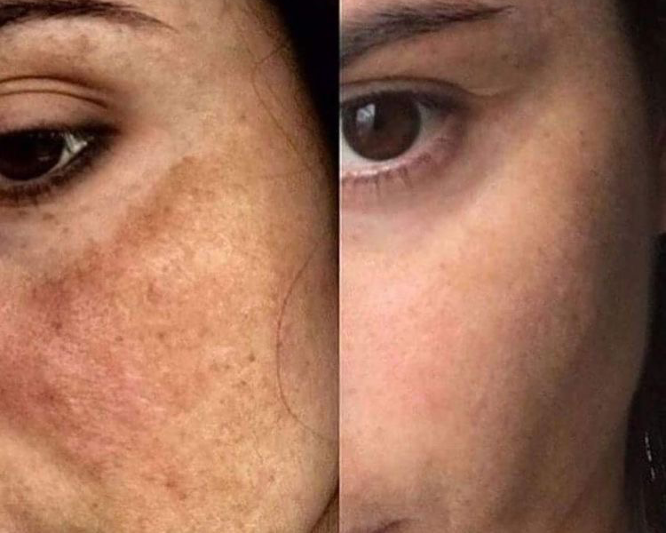 REDUCCION DE MELASMA (PAÑO)