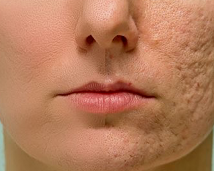 TRATAMIENTO SECUELAS Y MANCHAS DE ACNE 5