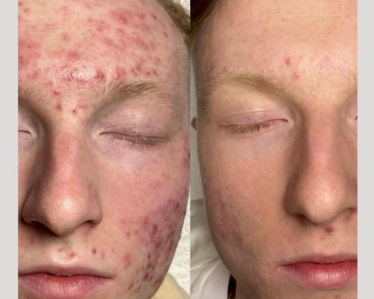 TRATAMIENTO CONTROL DE ACNE 5