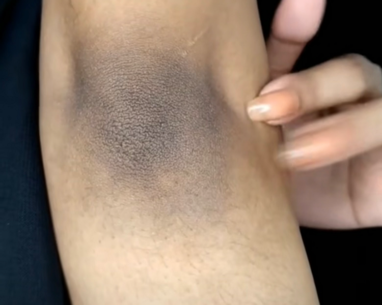 BLANQUEAMIENTO CODOS 5