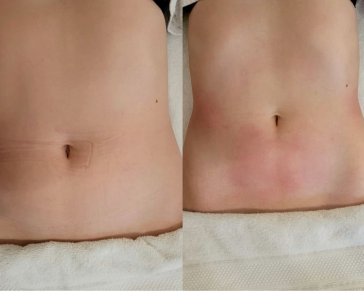 MADEROTERAPIA REDUCTIVA