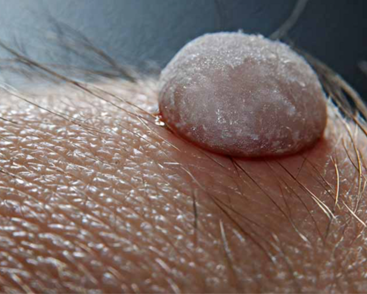 RETIRO VERRUGAS ZONA INTIMA