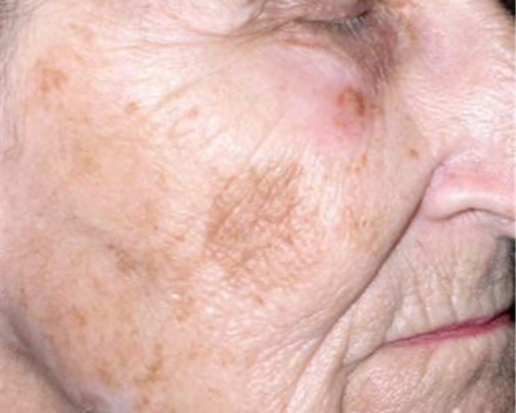 REDUCCION DE LENTIGO SENILES 