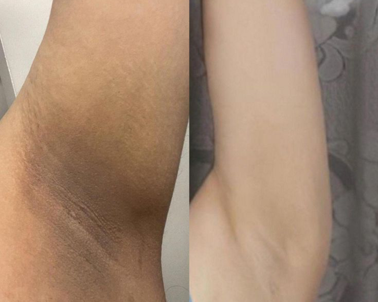 BLANQUEAMIENTO AXILAS 5