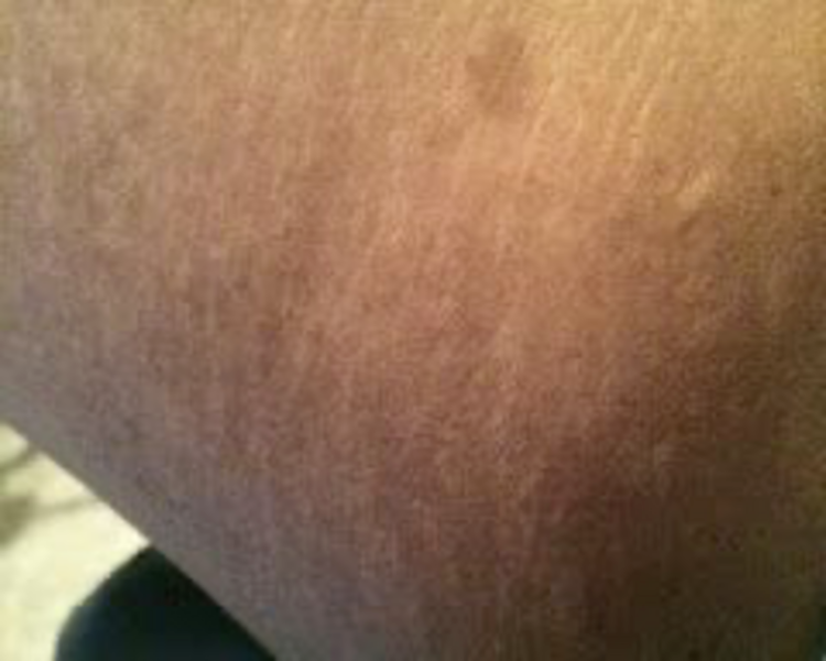 BLANQUEAMIENTO ENTREPIERNA 5