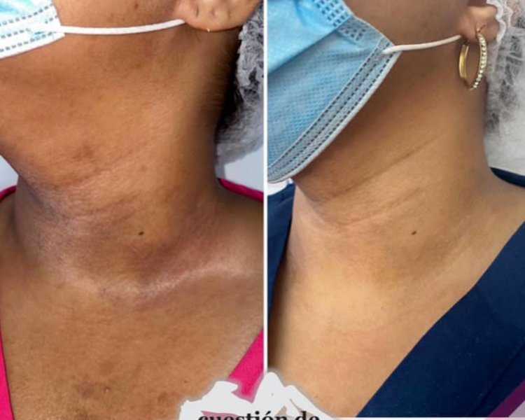 BLANQUEAMIENTO CUELLO 5