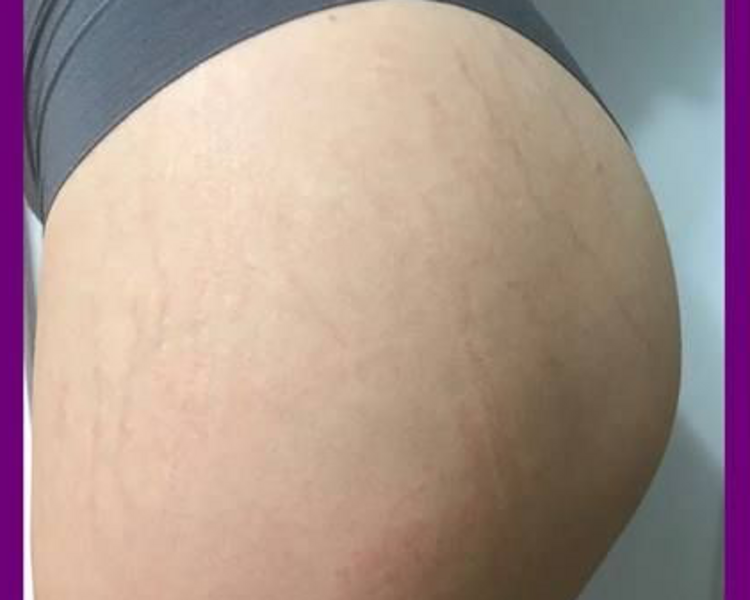 REDUCCION DE ESTRIAS DERMAPEN