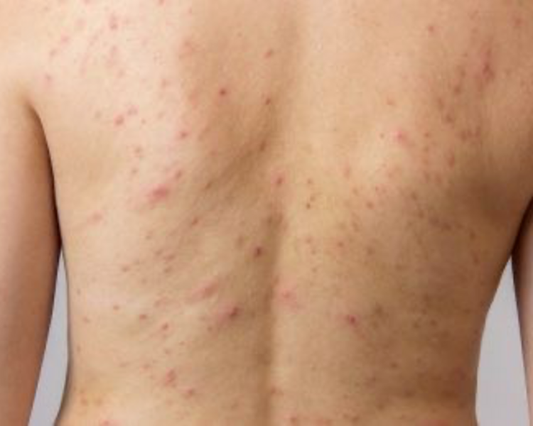 EXFOLIACION DE ESPALDA 