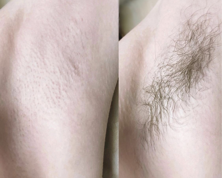 DEPILACION DE AXILAS 