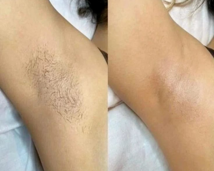 Cavado + Axilas  (MUJER)