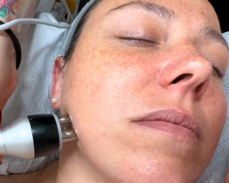 PACK RADIOFRECUENCIA FACIAL