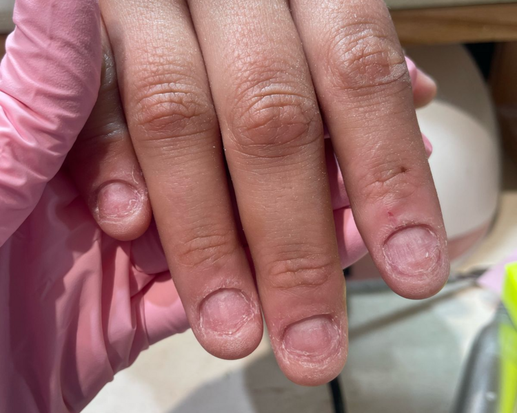 EXTENSION UÑAS MORDIDAS (ONICOFAGIA)