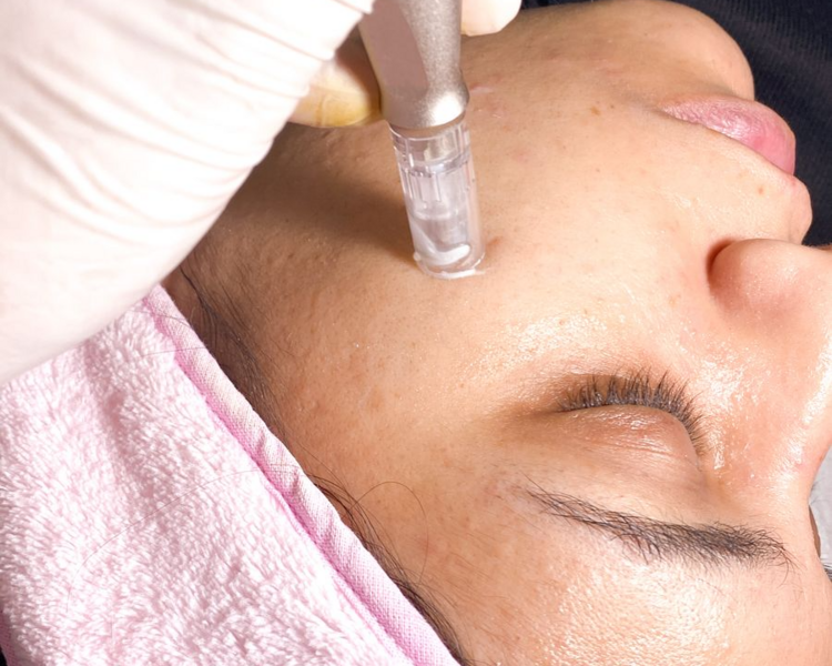 Dermapen facial