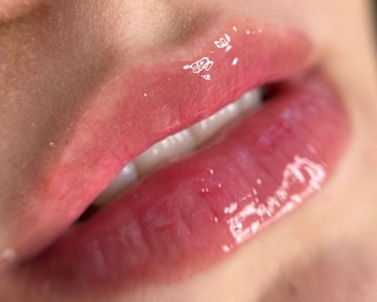 Dermapen hidralips