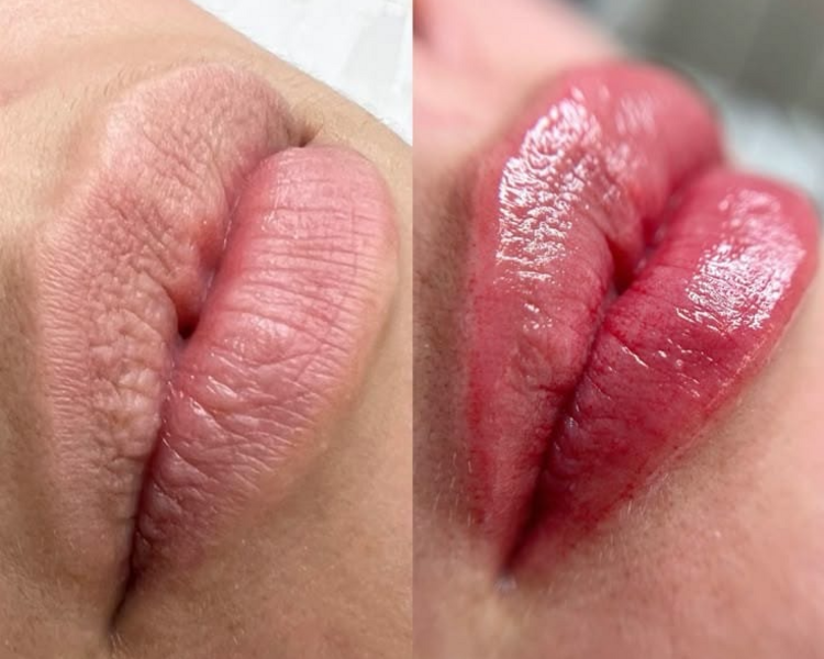 Dermapen hidralips