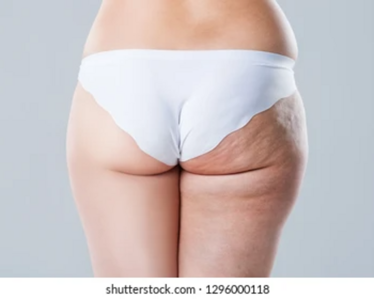 PAQUETE ANTI CELULITIS 