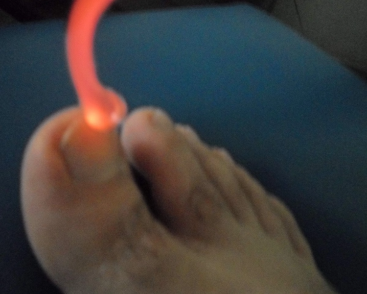 Podología Clínica + Tratamiento de Hongos