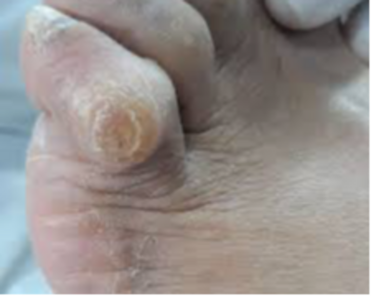 Pedicure