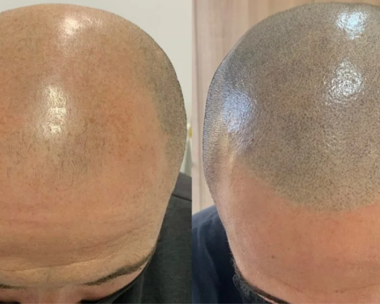 Efecto Rapado - Tricopigmentación