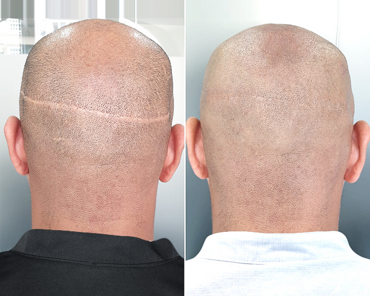 Corrección de Cicatriz en el cuero Cabelludo