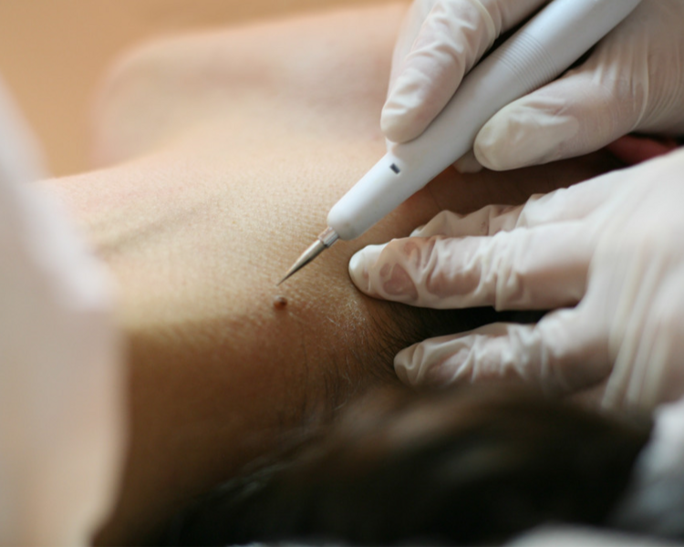 CAUTERIZACIÓN DE VERRUGAS, LUNARES Y ACROCORDONES