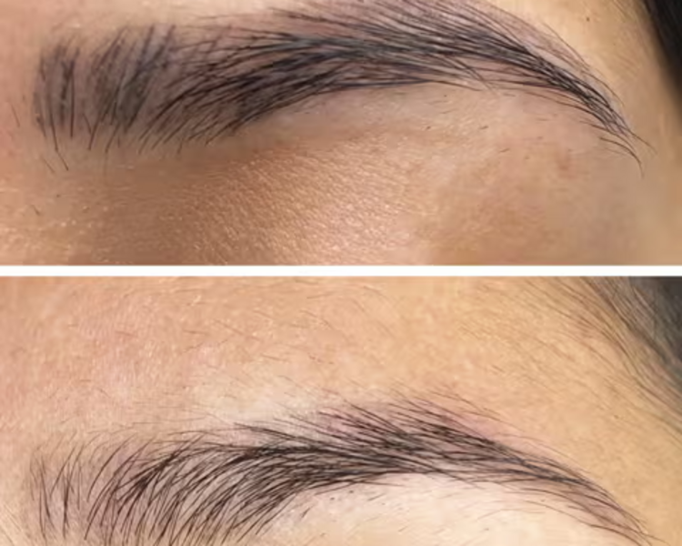 Remoción Micropigmentación mal realizada o tatuaje