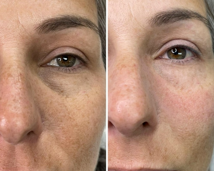 Aclaramiento de Ojeras - Sesión