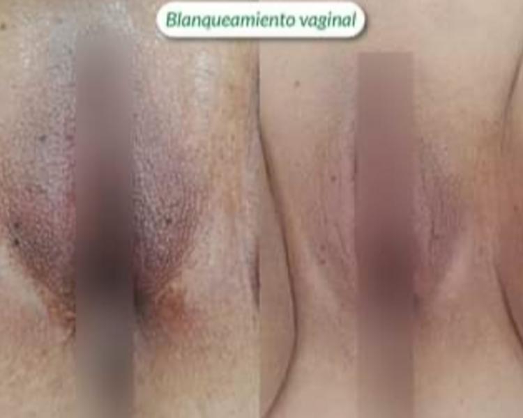 Aclaramiento de Entrepiernas - sesión