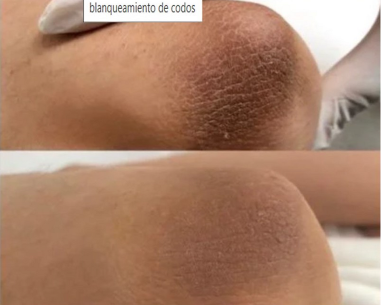 Aclaramiento de Codos - sesión