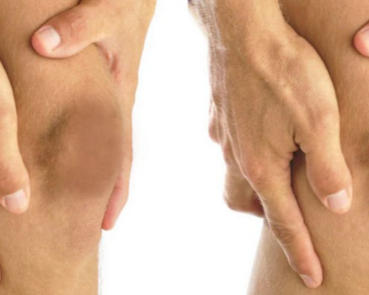 Aclaramiento de Rodillas - sesión