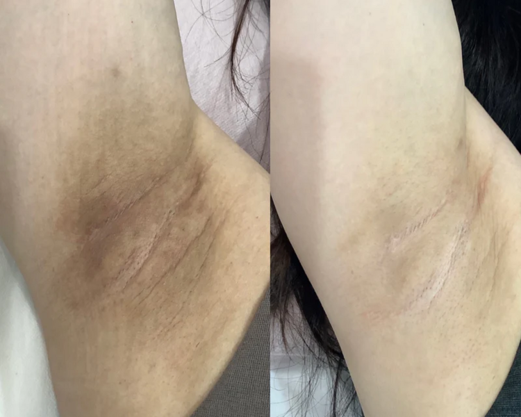 Aclaramiento Permanente de Axilas- sesión