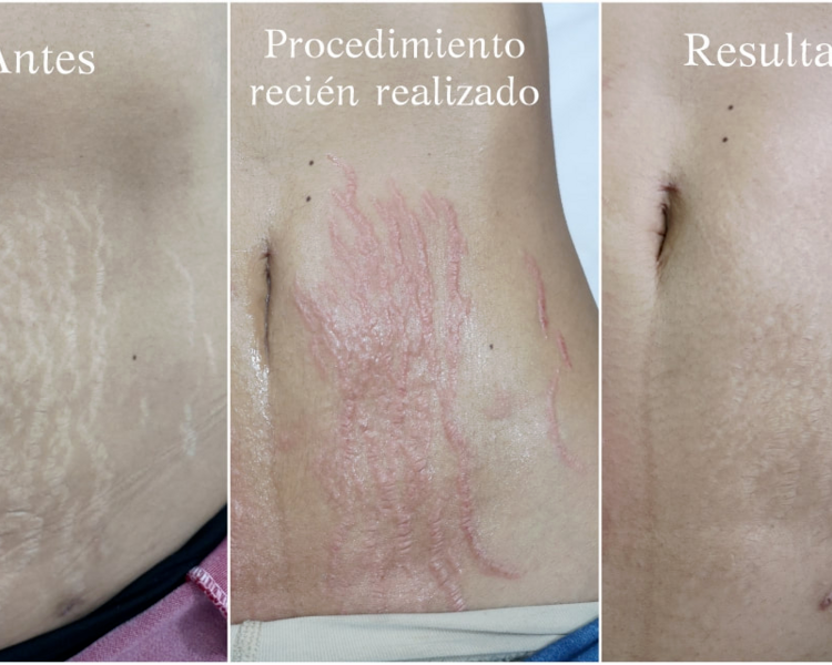 Camuflaje de Estrías area hasta 15x15 cm