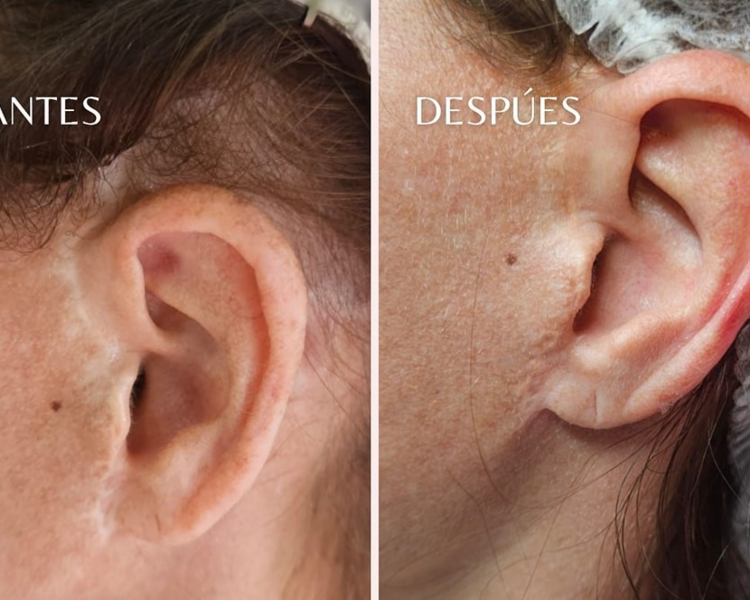 Dermopigmentación de Cicatriz (max. 15 cm x 15 cm)