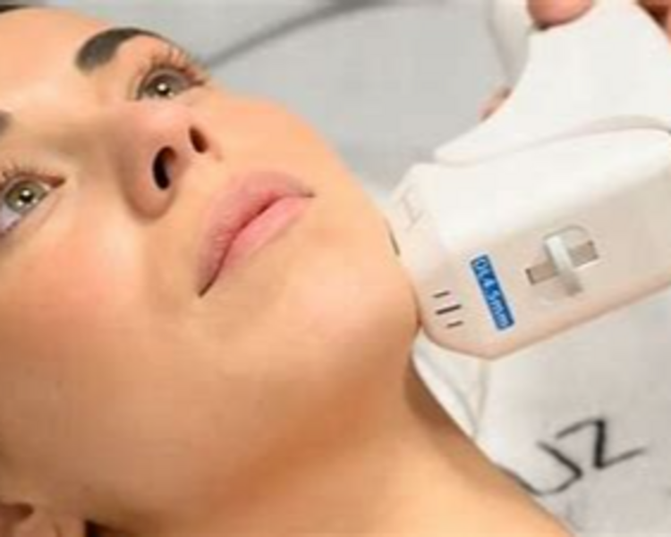 HIFU PAPADA Y CUELLO