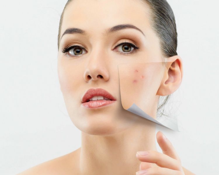 Facial Anti Acne Sayonara - 